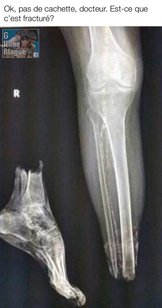 Docteur soyez honnêtes: c'est cassé ou pas? Une radiographie démontre clairement une fracture du pied